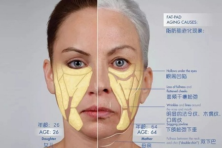 皱纹、松垂、凹陷，三大衰老症状，怎么解决？