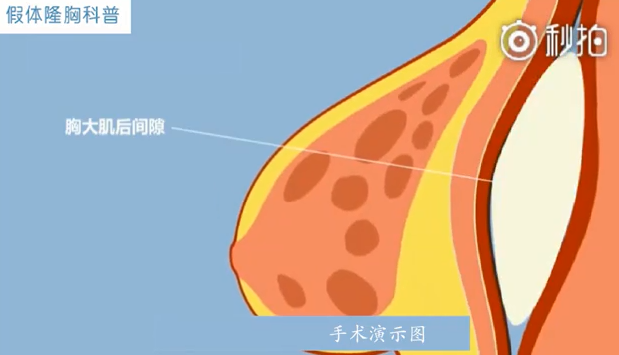 天津利来国际10秒带你了解假体隆胸科普