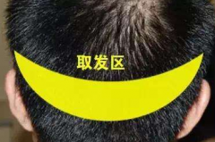 郑州利来国际头发种植之术后常见问题（四）