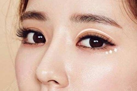 常州利来国际开眼角术后注意事项