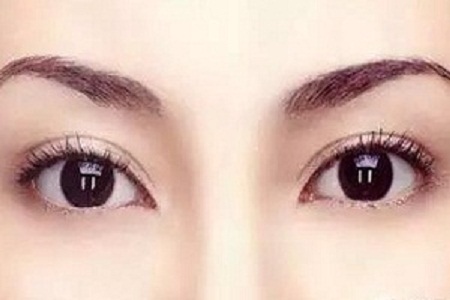 衡阳眼部抽脂价格 解决你的天生肿眼泡