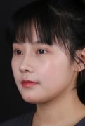 利来国际综合隆鼻术后让我拥有了绝美侧颜